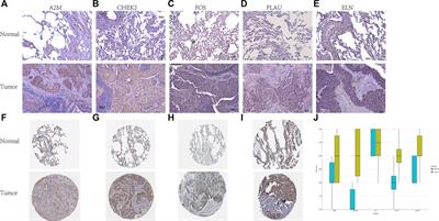 An Aging-Related Gene Signature-Based Model for Risk Stratification and Prognosis Prediction in Lung Squamous Carcinoma